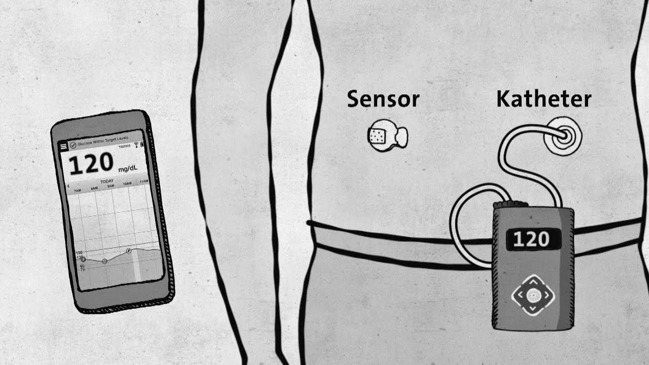 Kind 1 diabetes – modern technology with out approval – good to know