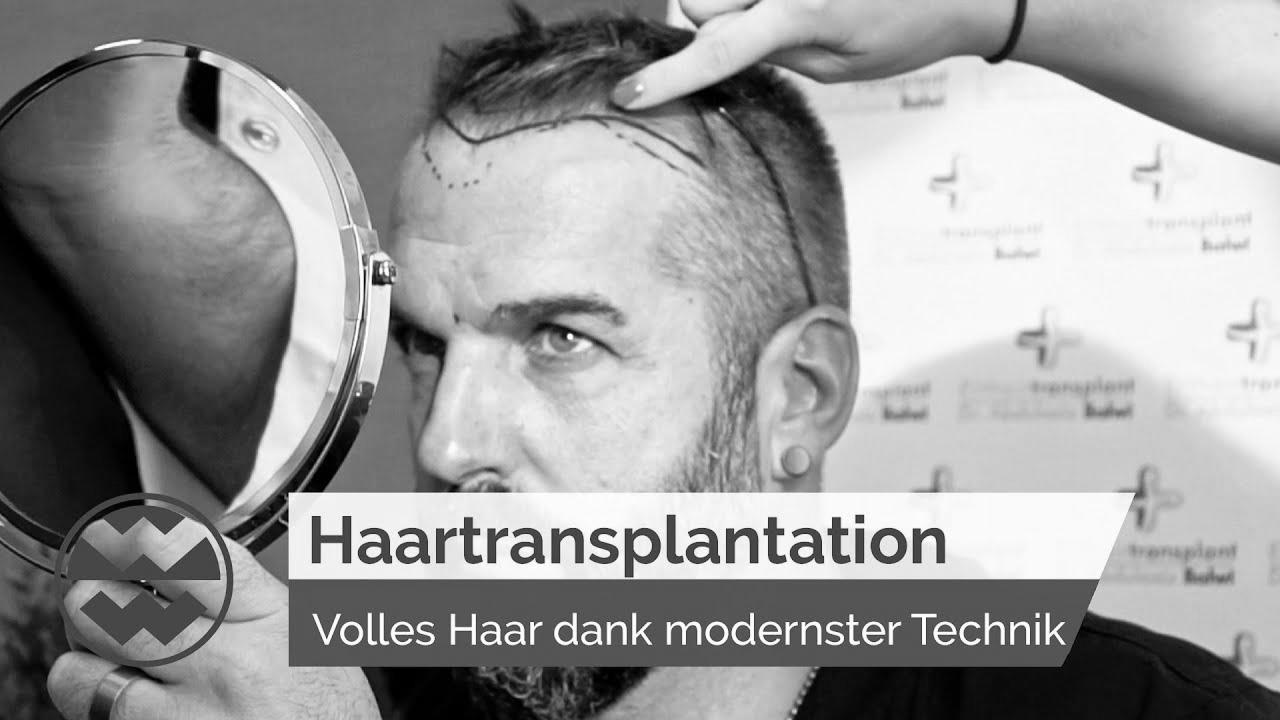 Hair Transplant: State-of-the-{Art|Artwork} {Technique|Method|Approach} for Full Hair – Life Goes On |  world of wonders